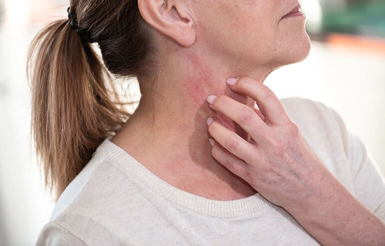 Alergia al frío o urticaria por frío: síntomas, causas y cómo evitar reacciones