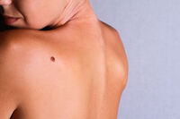 Melanoma y la regla del ABCDE para ‘escanear’ tu piel