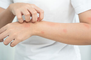 Por qué pican los mosquitos y cómo aliviar sus picaduras