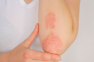 “Tengo psoriasis: qué debo saber y cómo puedo mejorar los síntomas”