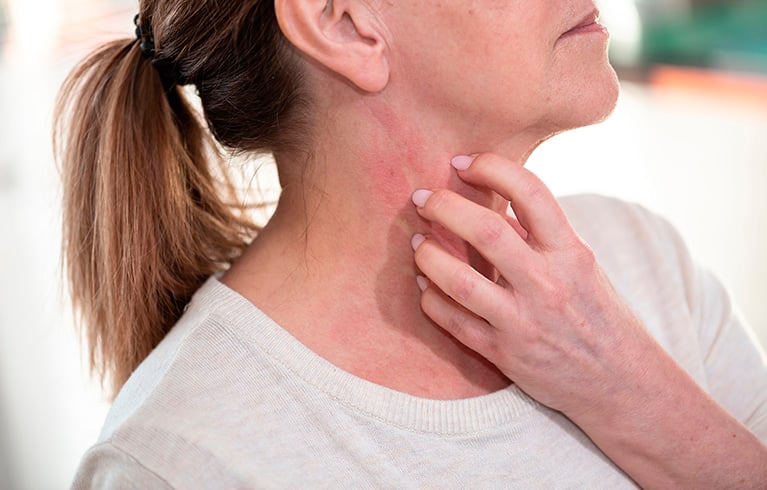 Alergia al frío o urticaria por frío: síntomas, causas y cómo evitar reacciones