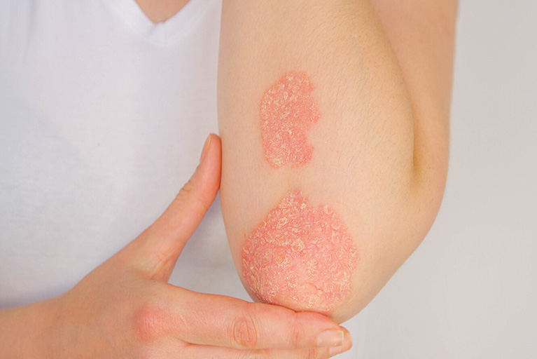 “Tengo psoriasis: qué debo saber y cómo puedo mejorar los síntomas”