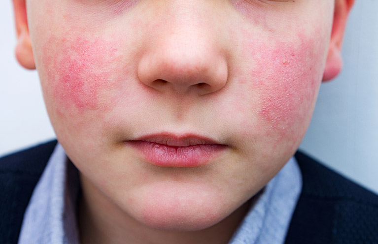 Qué es el ‘virus de la bofetada’ o parvovirus