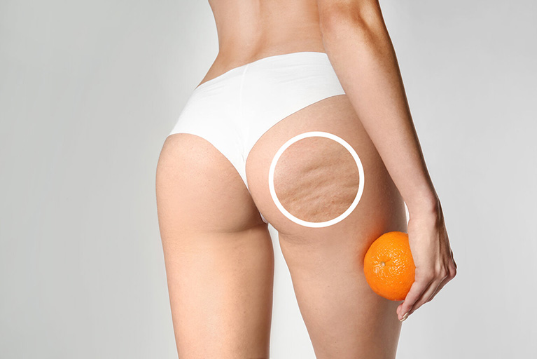 Cómo actúan los cosméticos anticelulíticos sobre la 'piel de naranja'