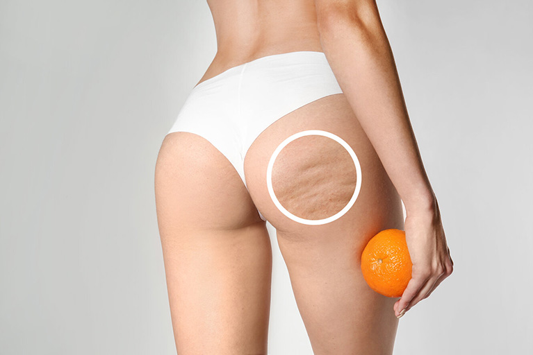 Cómo reducir la celulitis y mejorar la apariencia de la ‘piel de naranja’ con cosméticos anticelulíticos