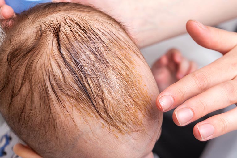 Mustela Bébé crema para niños para escamas en el pelo