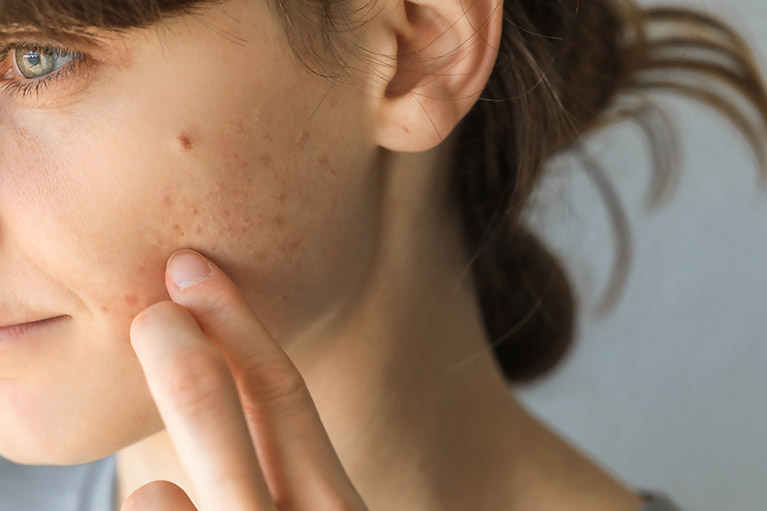 ¿Qué es el acné? 10 medidas para controlarlo