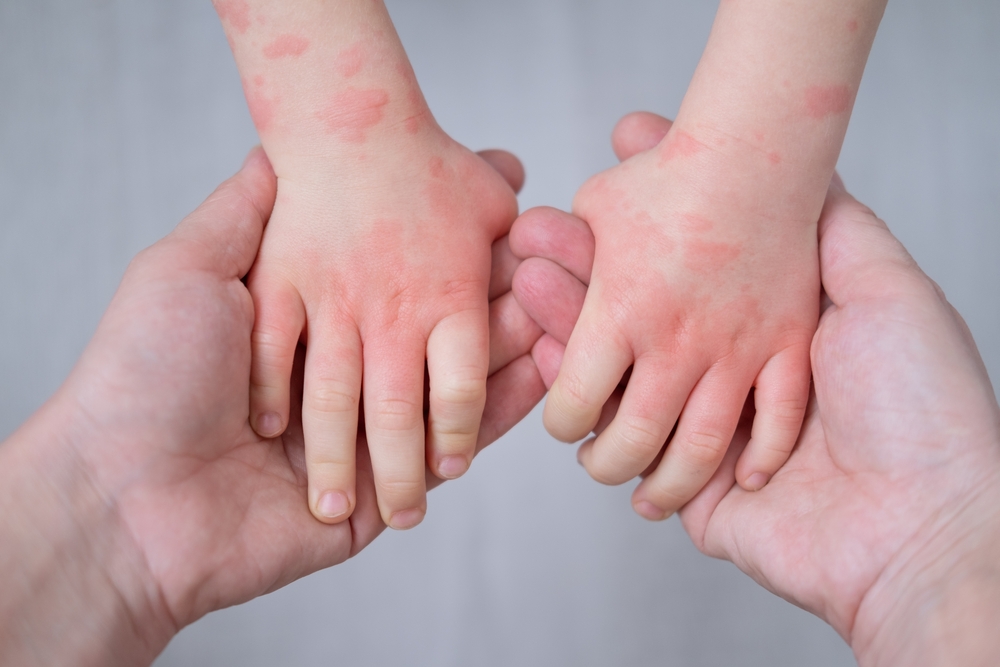 Dermatitis atópica: motivos de empeoramiento en otoño e invierno
